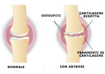 Il ginocchio - patologie degenerative